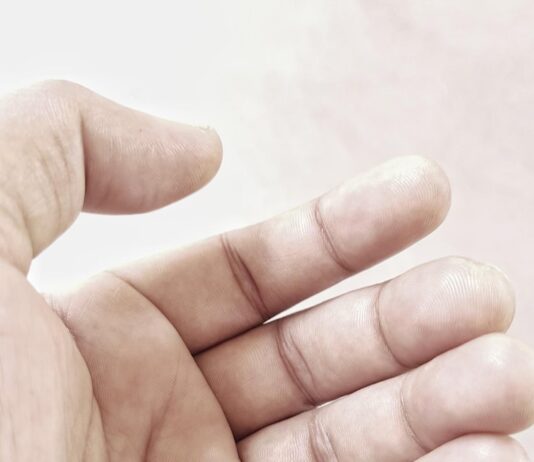 Чешется палец на левой руке безымянный: причины и решения